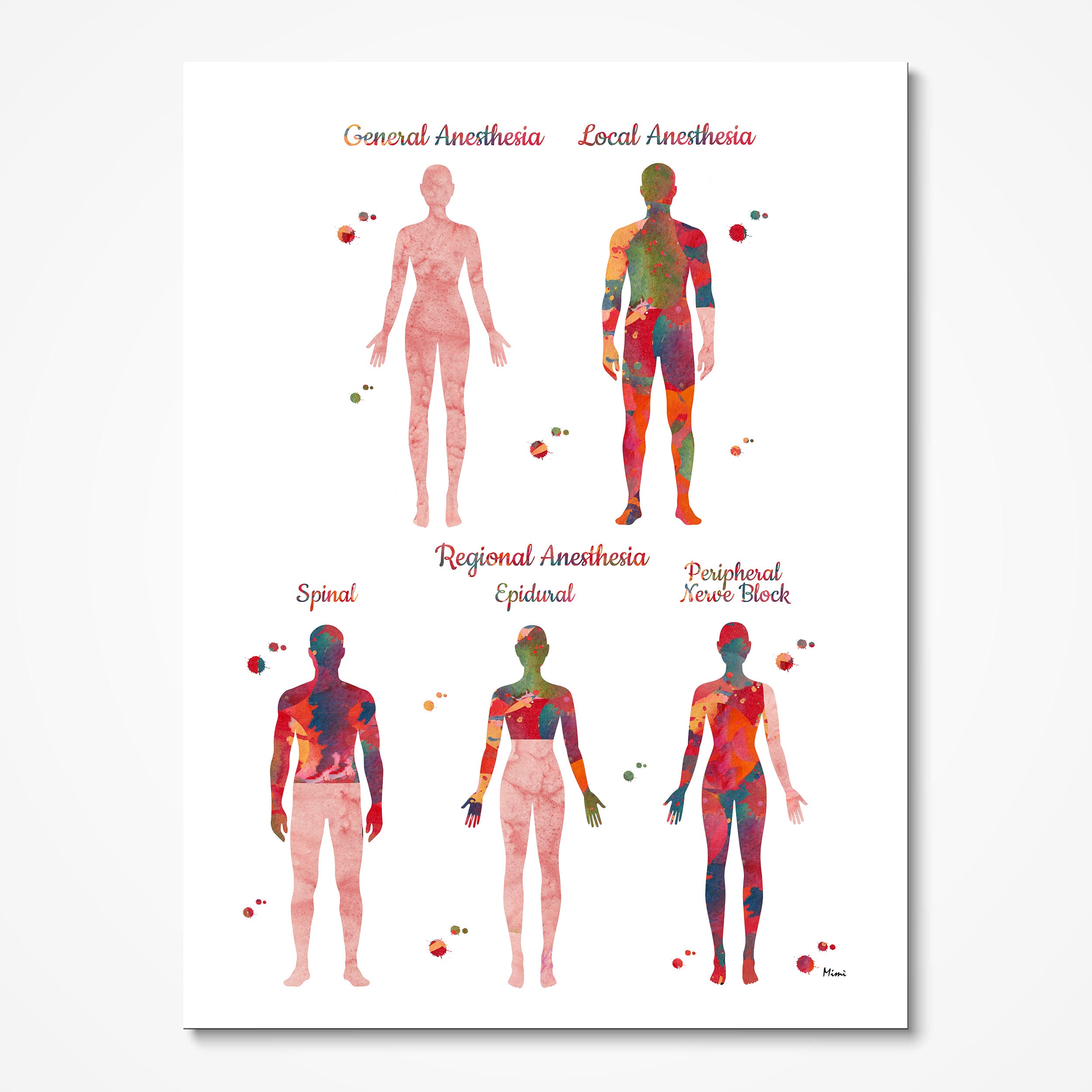 Illustration of human bodies with different anesthesia methods labeled on a white background
