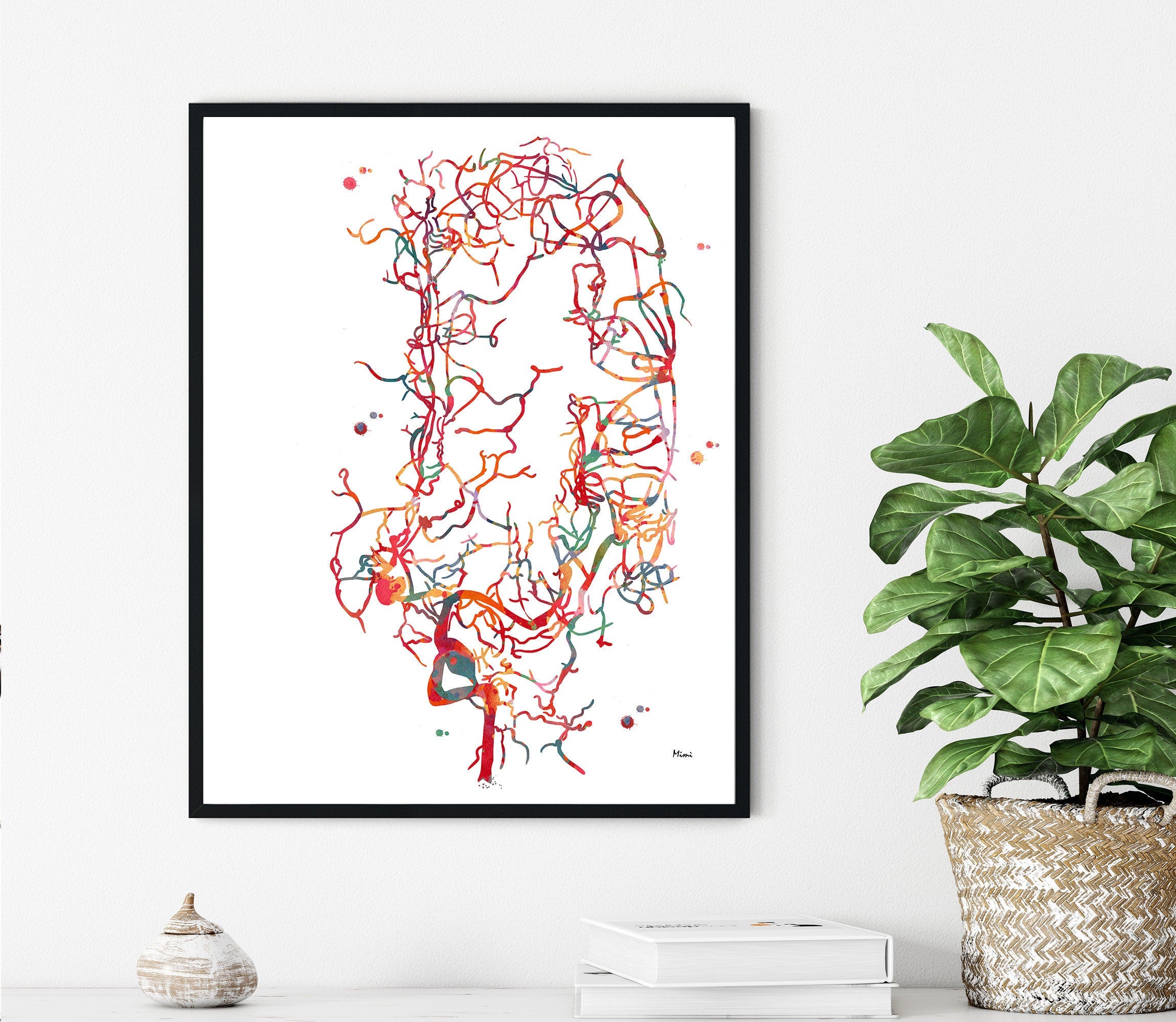 Brain Aneurysm Watercolor Print Cerebral Aneurysm Anatomy Image 2