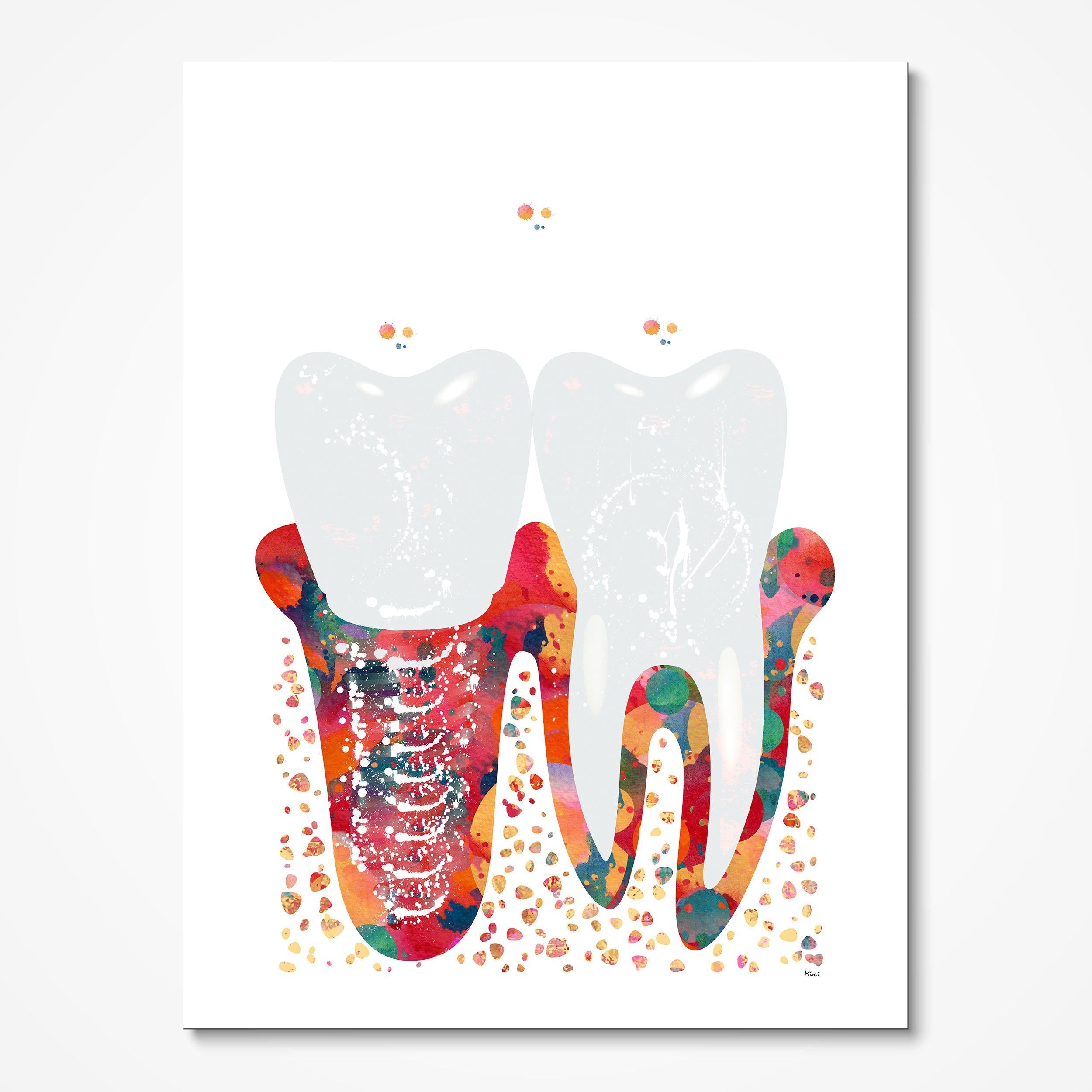Molar Implant watercolor art print for dental clinic wall decor