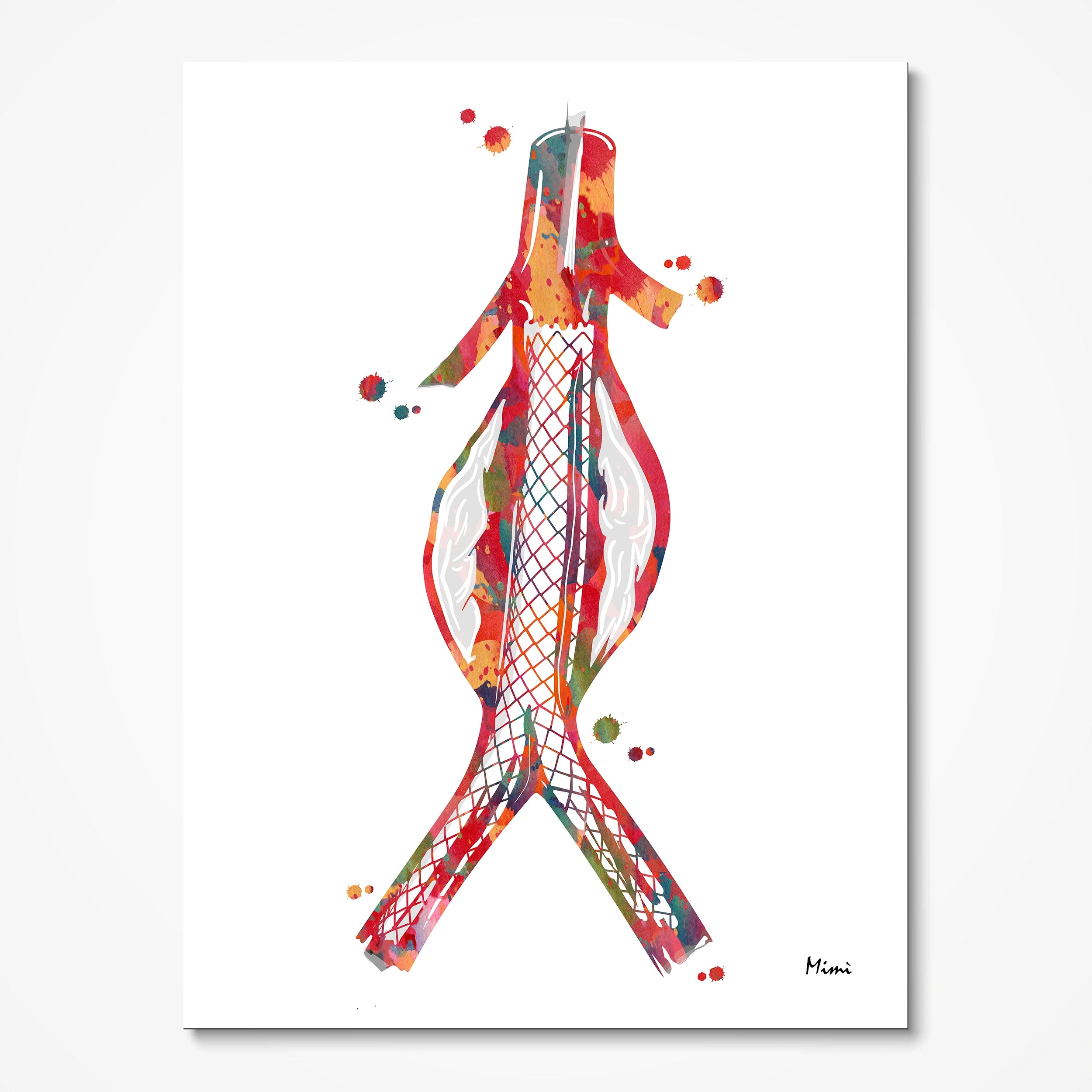 Abdominal aortic stent watercolor art print for vascular clinic wall decor