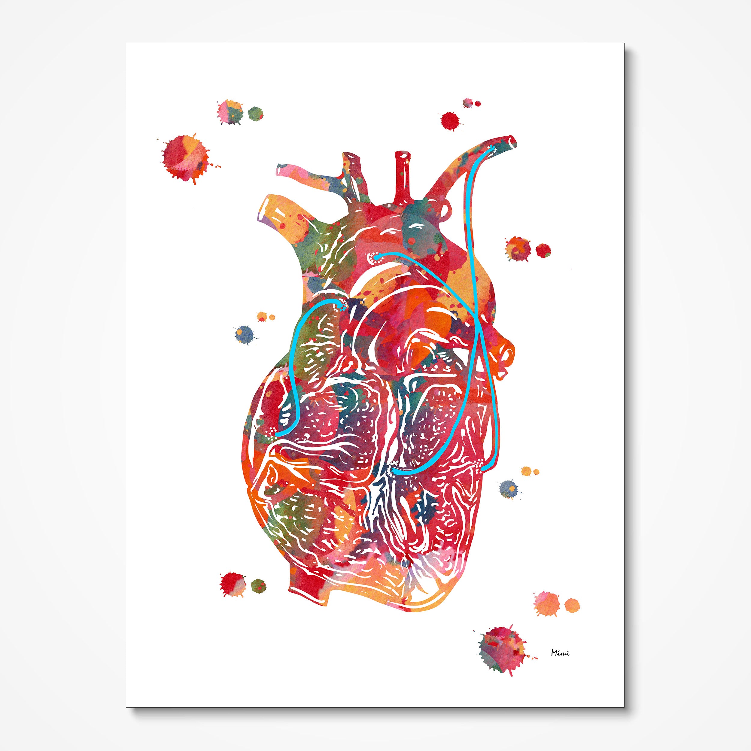 Coronary artery bypass CABG watercolor art print for cardiac surgery wall decor