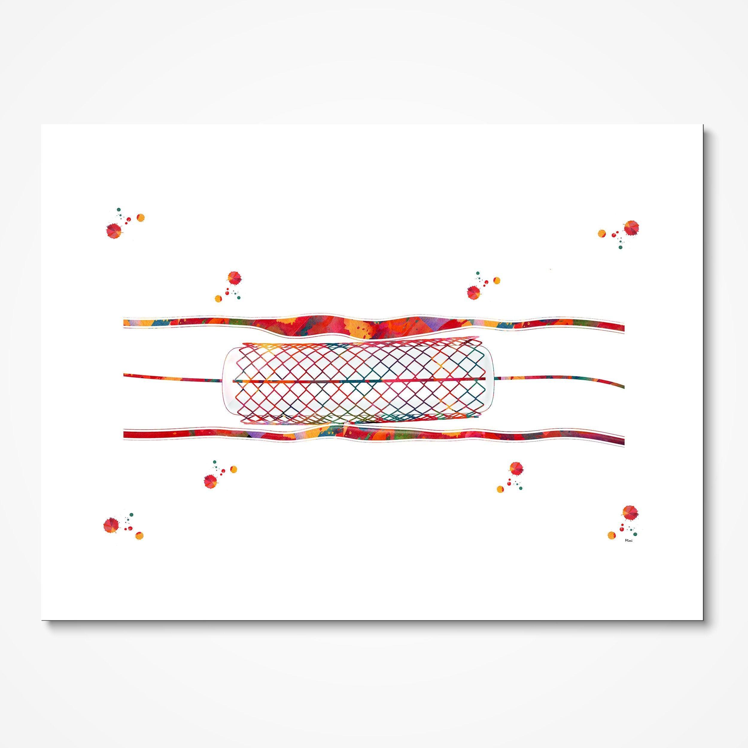 Coronary stent angioplasty watercolor art print for cardiology clinic wall decor